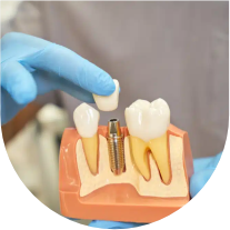 Implante e Prótese Dental